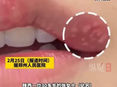 女子嘴角起泡不以為意，感染皰疹性腦炎致腦死亡，醫生：有這些癥狀快就醫
